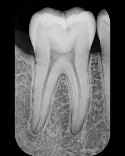 Radiografía periapical